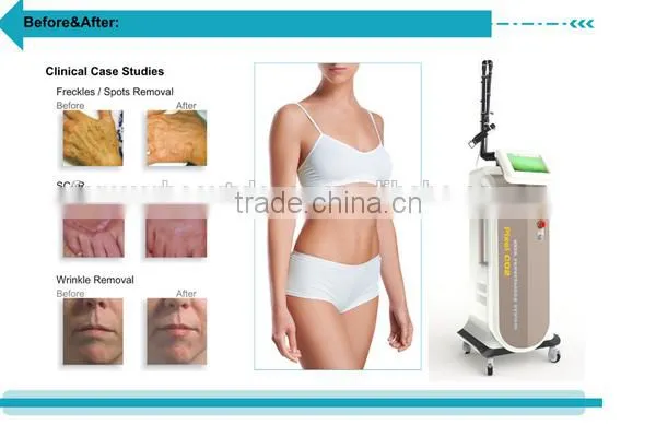 Big discount for High power RF tube CO2 fractional laser vaginal tightening skin resurfacing beauty machine--CV-I