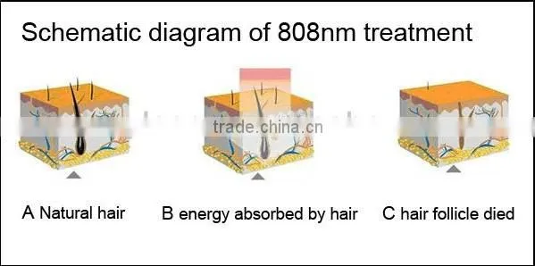 fast Diode laser hair removal