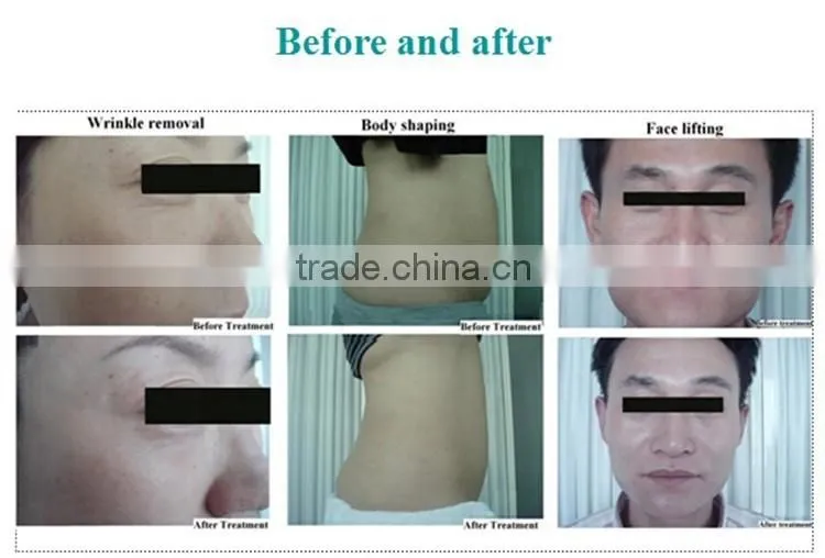 RF vacuum roller sliming machine ,face vacuum suction machine