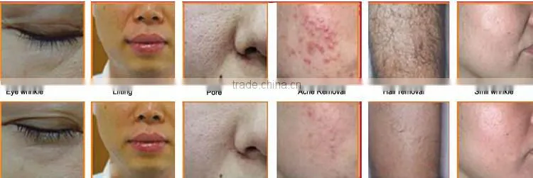 Rechargable filters Shr Ipl Elight Hair Removal Machine for man and woman With CE