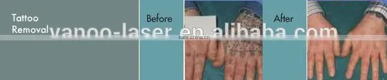 # q switched nd yag laser tattoo removal machine