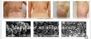 Cavitation Machine for Weight Loss