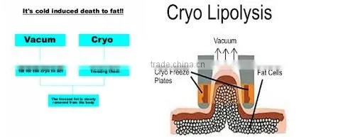 Professional 5 handles fat freezing cryolipolis ultrasonic liposuction cavitation slimming machine