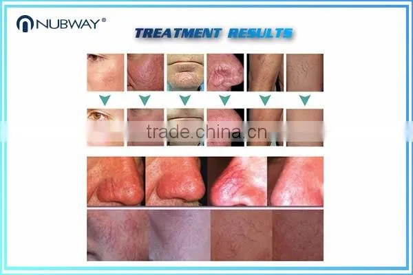 Pigment Removal/ Pigmentation Correctors/ Spider Vein Removal Equipment
