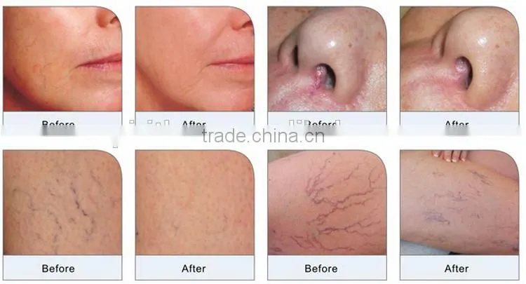 Spiritlaser fda approved diode laser equipment vascular remover 980nm Diode Laser Vascular Removal Laser Treatment
