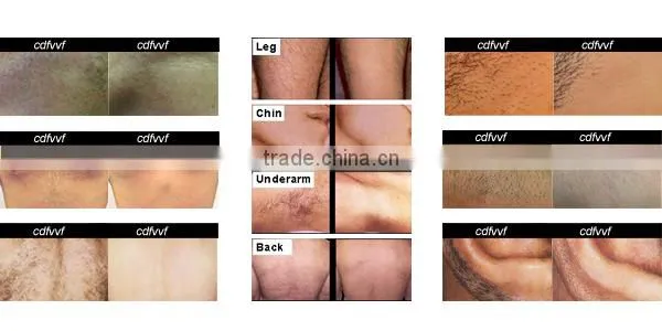 Top seller! depilacion laser 808 Diode body hair removers for man/ diode laser 808nm depilator