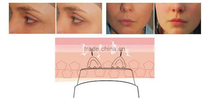 At home cellulite reduction portable beauty device