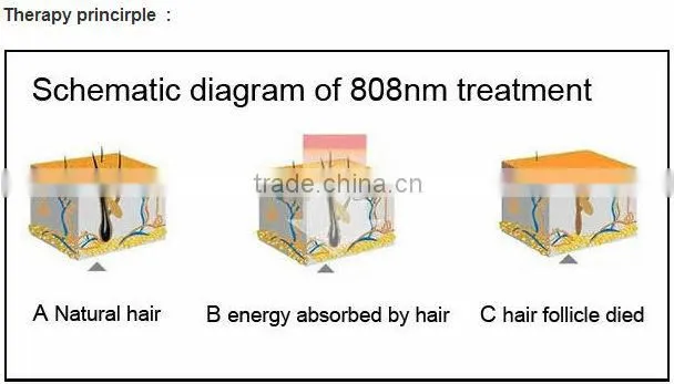 medical 808nm diode laser hair removal machine HS 811 laser hair removal device painless by shanghai apolo medical technology