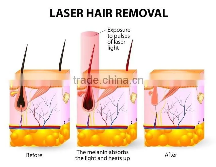 808 diode laser for hair removal with Alex for permanent hair removal