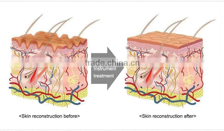 OSANO hair removal facial rejuvenation laser equipment for home use