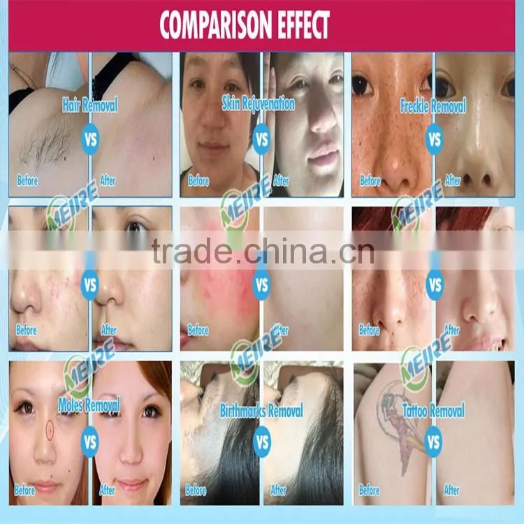 CE certificate 2016 hottest 4 in 1 multifuctional beauty equipment