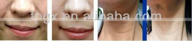 Excellent quality new products electroporation beauty machine