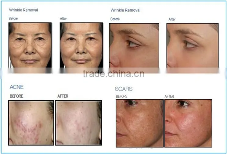 Facture price scar removal co2 lazer body