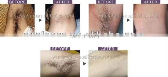 Best Hair removal machine S3000 CE/ISO ipl shr hair removal machine IPL OPT SHR