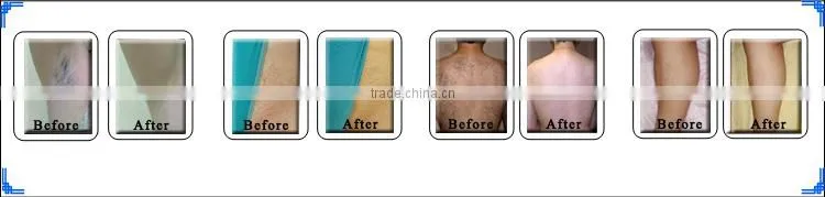 12 Years Professional Beauty Machine Manufacturer Depilation E-light Skin Rejuvenation shr