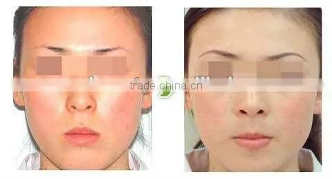 Tank E-light IPL hair removal machine