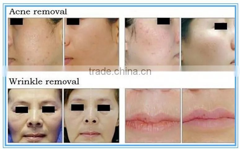 medical equipments co2 laser for acne scar removal