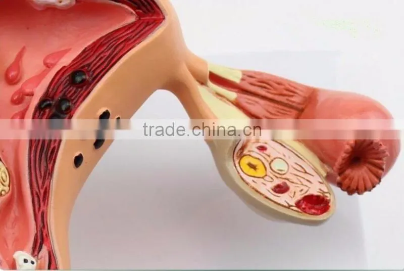 Human uterus and ovary vaginal pathological changes model of reproductive Department of gynecology medical demonstration model