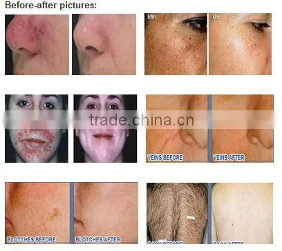 Latest 3-handles ipl laser hair removallive ipl cricket match video