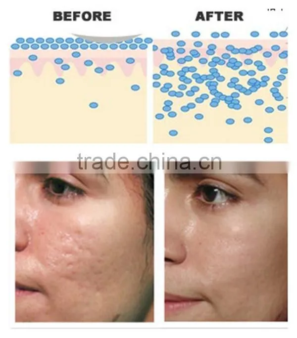 hot sale face microneedle therapy 540 derma roller micro needle derma roller