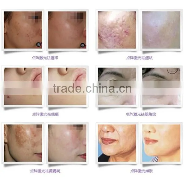 2015 hot selling!! rf co2 fractional laser machine/Co2 fraccional laser