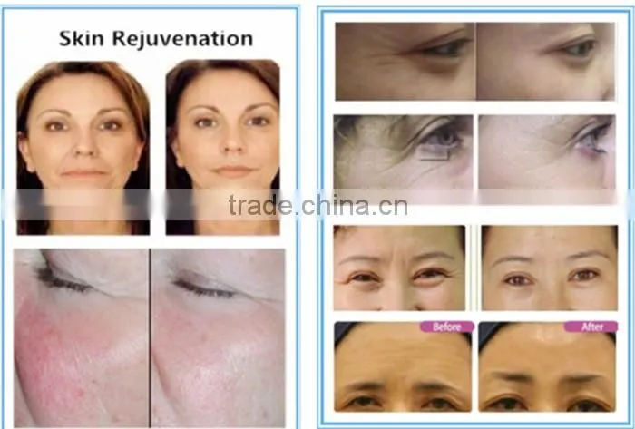 medical ce approved permanent Hair Remove device SHR hair removal IPL