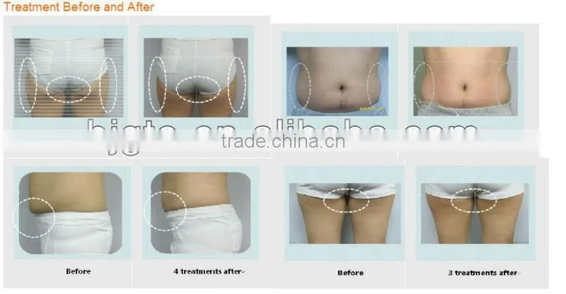2015 new cavitation vacuum RF slimming machine weight loss machine