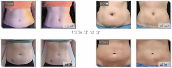 hifu ultrasound for noninvasive lipo cavitation