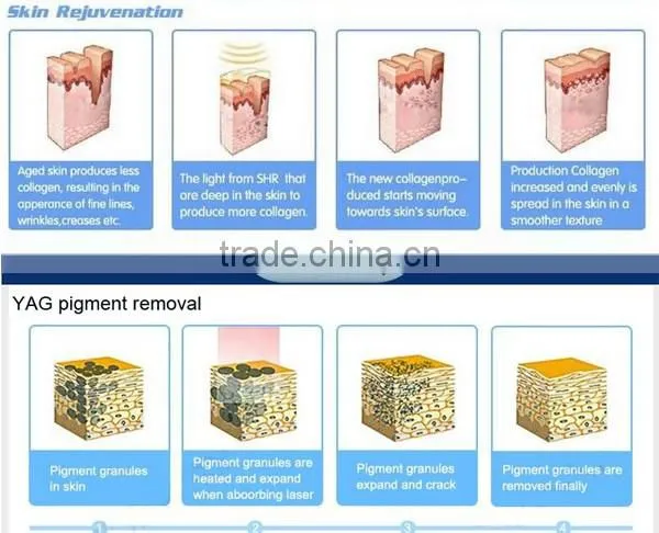 Aispirit combination machine YAG laser removal pigment and SHR handle for fast hair removal