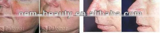nd yag laser hair removal long pulse laser Skin Rejuvenation equipment