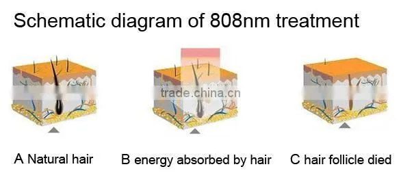 Multi-functional diode laser beauty machine for hair removal/skin whitening and lift/acne treatment