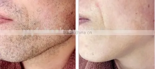 looking for exclusive distributor for body hair removal diode laser machine