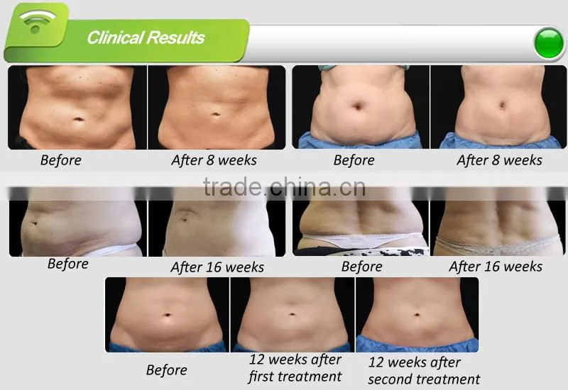 cryolipolysis slimming machine,10pcs medium anti-freeze membranes,Professional manufacturer in China&Fast and safe delivery