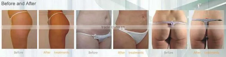 Face Lifting Skin Tightening RF Beauty Machine