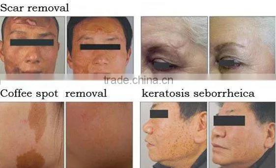 2011 CO2 Fractional Laser Machine for skin rejuvenation and wrinkle removal