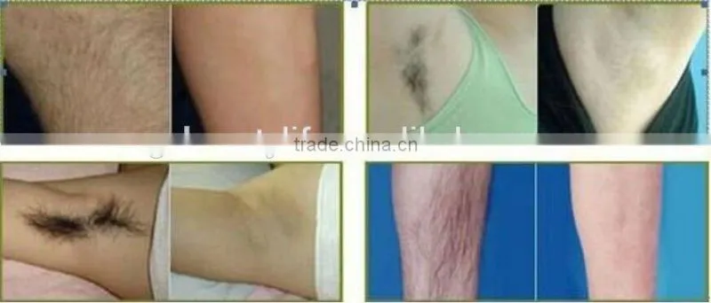 Protect the skin laser hair removal machine