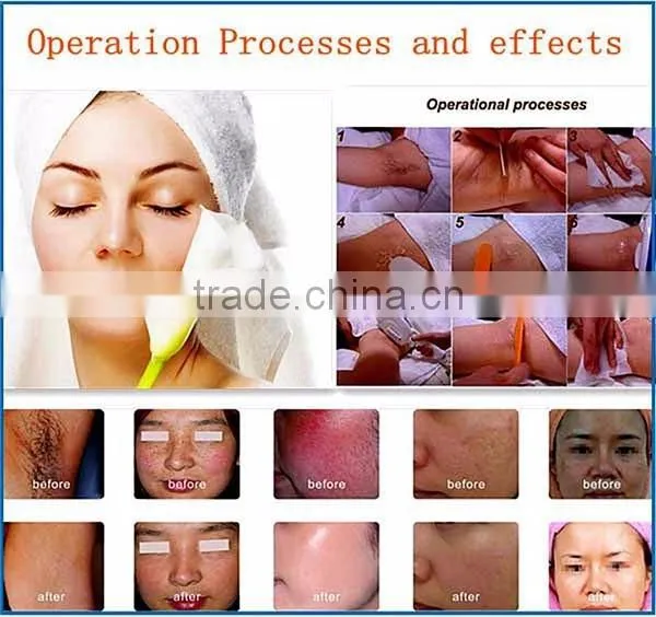 Skin Whitening Treatment/Laser Hair Removal SHR IPL Machine Laser Treatment For Skin Whitening