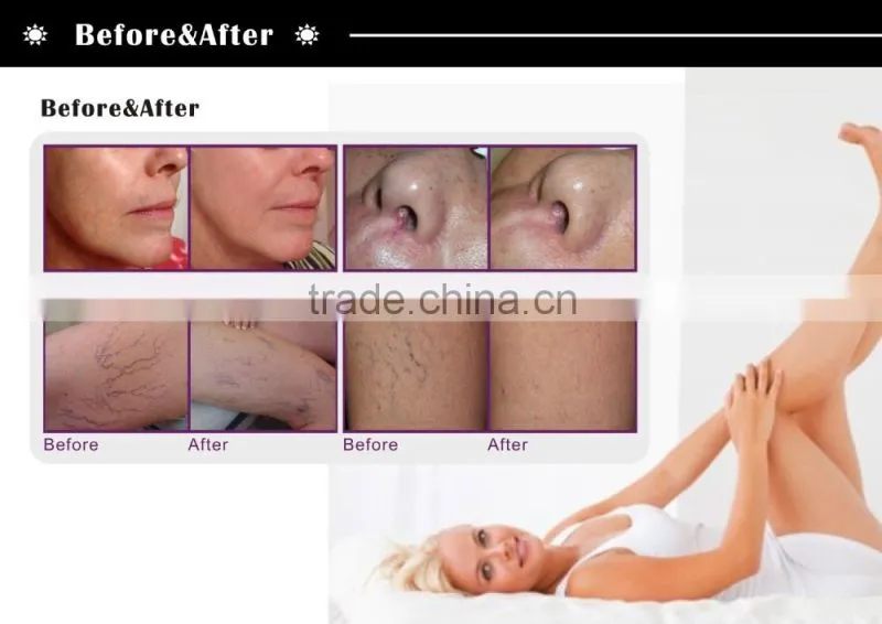 High Radio Frequency Portable Spider Vein Removal Machine