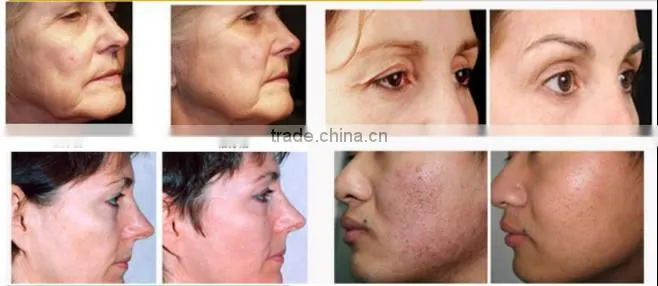 AYJ-M08 home use microneedle fractional rf, double chin removal machine