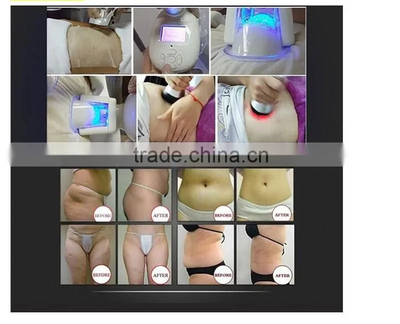 Hottest Professional Cool Body Sculpting Machine With Cavitaion & Multipolar RF
