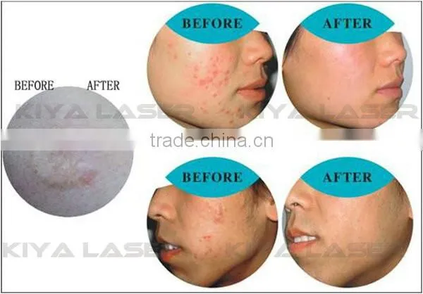 Factory Promition price! home use oxygen facial machine