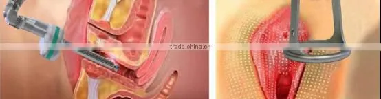 rf co2 fractional laser equipment / rf driver fractional co2 laser / vaginal tightening laser