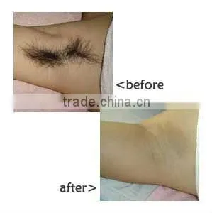 Permanent Laser hair removal freckle removal beauty machine P003