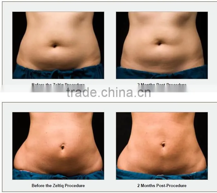 2014 CE FDA approval freezing fat laser slimming machine