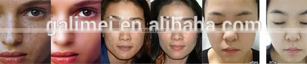 High quality PDT led machine/led bio light facial beauty device