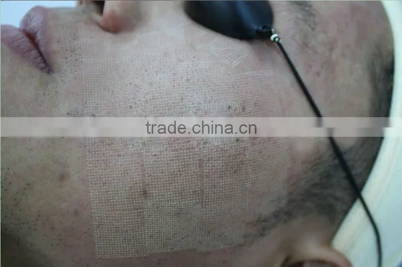 fractional co2 laser acne scar removal