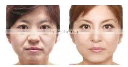 Beauty supply skin tightening thermagic rf machine