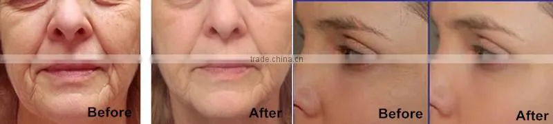 (CE Certified!) new mini Bipolar RF the skin for wrinkle removal and skin tightening