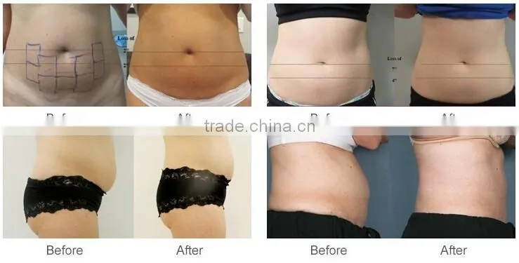 Lipo HIFU /LipoHIFU ultrasound Slimming System HIFU-10