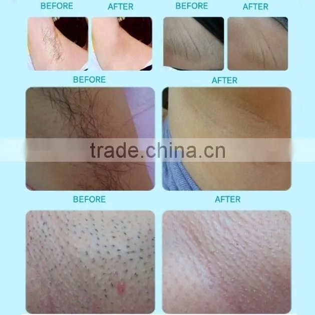 New Product in 2016 Portable Hair Removal Device!!! OPT SHR IPL Machine Hair Removal Laser with Teaching Video